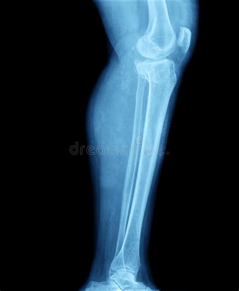 X Ray Leg