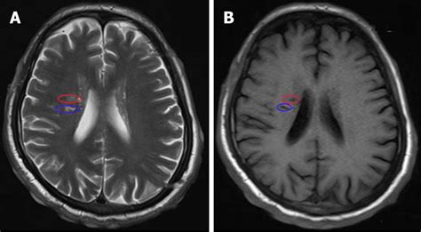 Magnetic Resonance Imaging Revealing Abnormal Hyperintense Lesions In