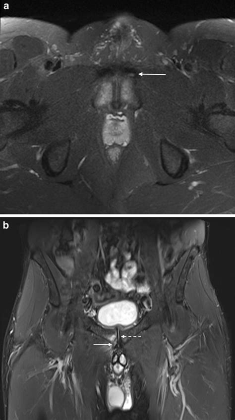 A Axial Fat Saturated T2 Weighted Mri Of The Pelvis In A 67 Year Old Download Scientific