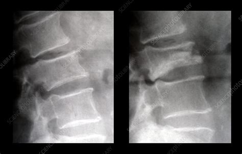 Lumbar Compression Fracture - Stock Image - M330/1636 - Science Photo Library