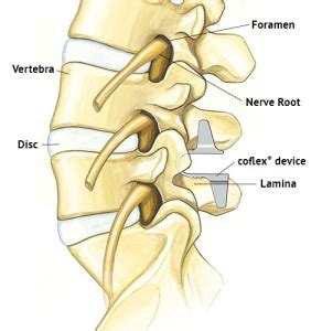 Coflex | Neurotexas