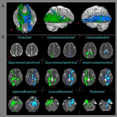 A Results Of Diffusion Tensor Tractography Of The Neural Connectivity