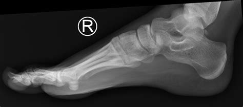 Xray Of Normal Foot