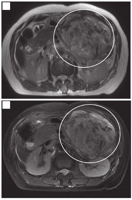 A The Tumor Exhibits Low Intensity Signal On A T1 Weighted MRI B