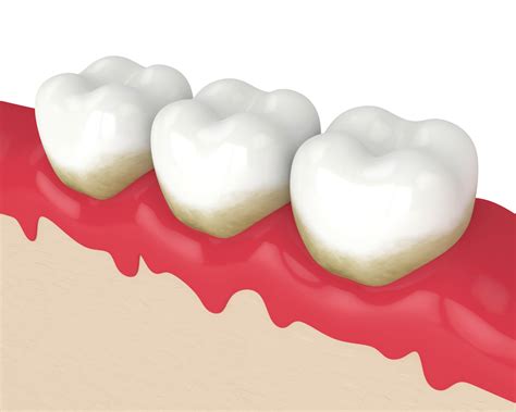 What To Do If You Have Gum Disease - parkplazadentalcare.com