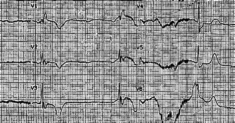 Dr. Smith's ECG Blog: Emergency Transvenous Cardiac Pacing