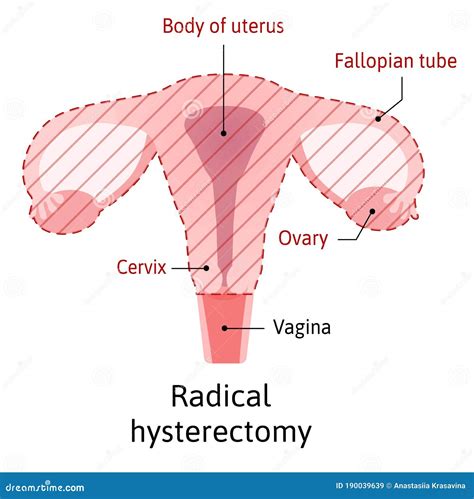 Hysterectomy Surgical Removal Of The Uterus Medical Vector