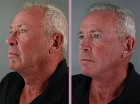 Old Man Before And After Plastic Surgery – Telegraph