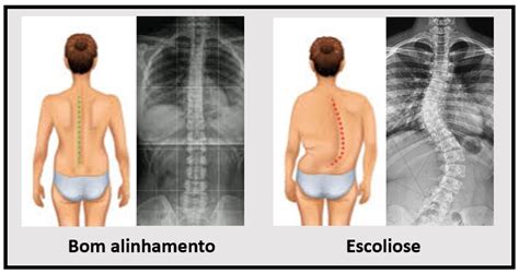 Escoliose O Que Causa Diagn Stico E Tratamento