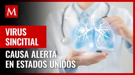 Qué es el virus respiratorio sincitial síntomas y cuidados Grupo Milenio