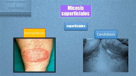 Micosis Superficiales Y Cutáneas