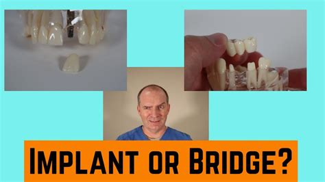 What Is Better Dental Implant Or Bridge Youtube