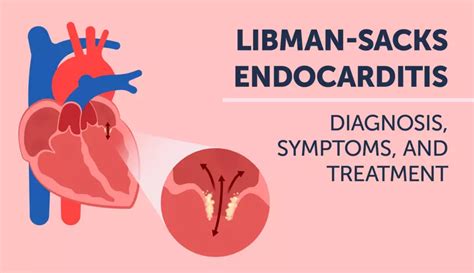 Libman-Sacks Endocarditis: Diagnosis, Symptoms, and Treatment ...