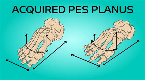 ACQUIRED PES PLANUS Insoles And Orthotics Healthy Step