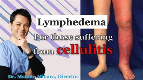 【for Lymphedema Patients】preventing Cellulitis In Lymphedema The