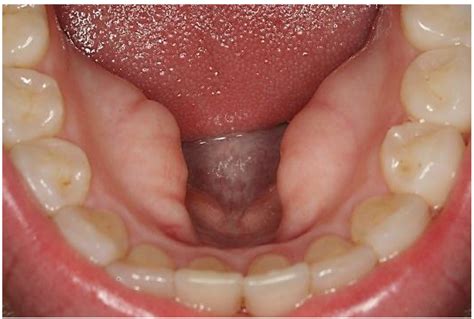 Normal Oral Cavity Findings And Variants Of Normal IntechOpen