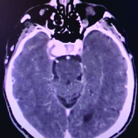 Brain Computerized Tomography Angiography Image With 3d Reconstruction Download Scientific