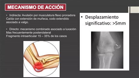 Fractura De Epicondilo Medial Y Lateral Pptx