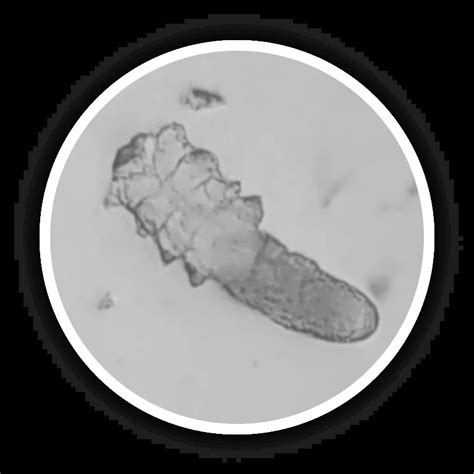 Demodex Blepharitis Xdemvy