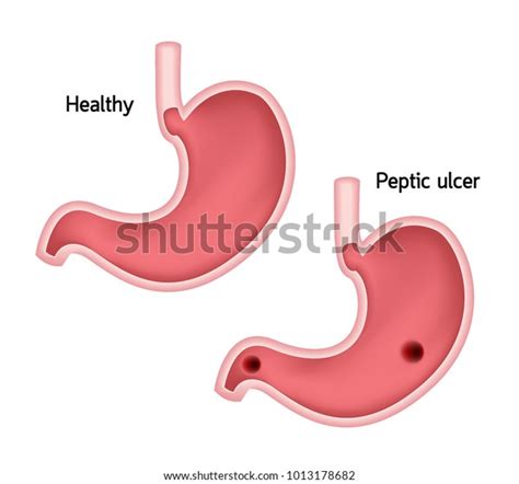 Stomach Comparison Healthy Ulcer Human Stomach Stock Vector Royalty