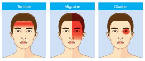 302 - hot sore head - headaches Flashcards | Quizlet