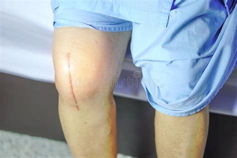 Scars Surgical Knee Surgery Stock Image - Image of bruise, female ...