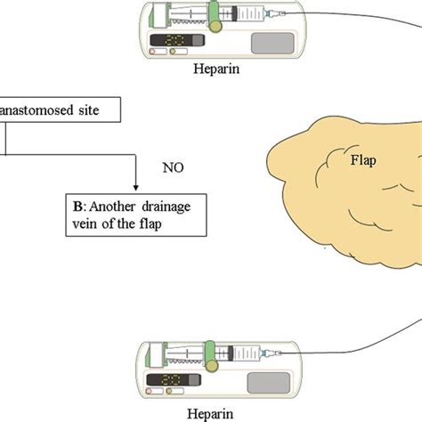 Pdf Continuous Local Intravenous Heparin Infusion After Re