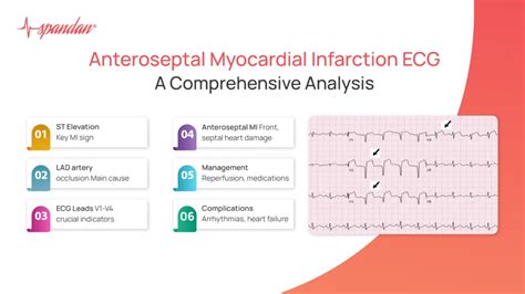 Understanding Anteroseptal Myocardial Infarction Ecg