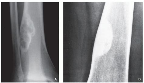 Fibrogenic Fibro Osseous And Fibrohistiocytic Lesions Radiology Key