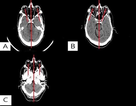 Non Contrast Head Ct Showing A Right Vestibular Neuronitis Nystagmus Download Scientific