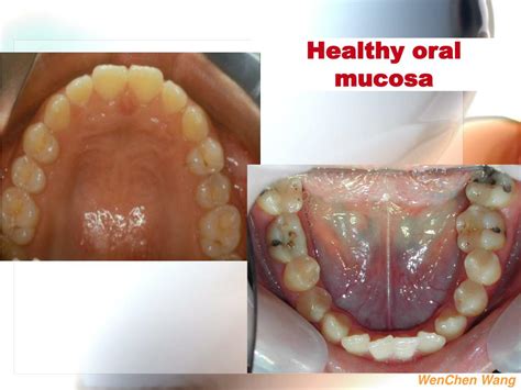 PPT - 1. White lesions of the oral mucosa 2. Solitary oral ulcer and ...