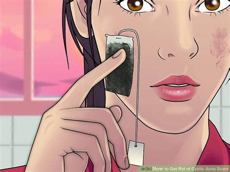 4 Ways to Get Rid of Cystic Acne Scars - wikiHow