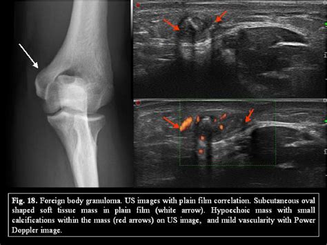 BENIGN LESIONS OF THE SUBCUTANEOUS SOFT TISSUE WITH CALCIFICATIONS