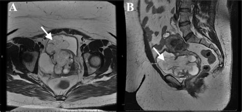 A Transverse And B Sagittal T2 Weighted Mri Images Demonstrating