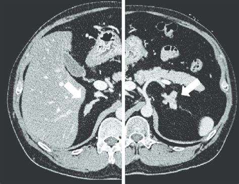 Figure1 Abdominal Computed Tomography With Contrastenhanced Medium Download Scientific Diagram