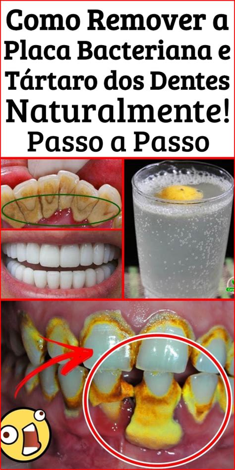 Como Remover A Placa Bacteriana Em Minutos Sem Ir Ao Dentista