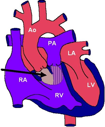 Double Outlet Right Ventricle (DORV) | Drug Attorneys