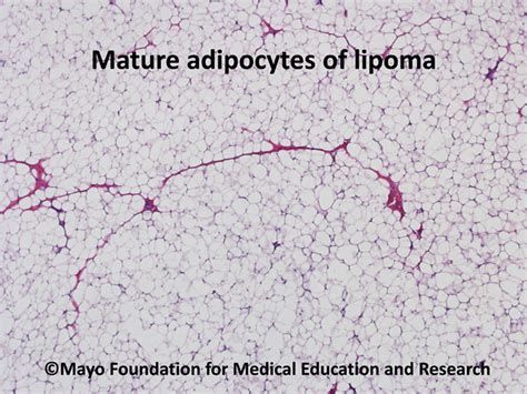 Lipoma Mayo Clinic Proceedings