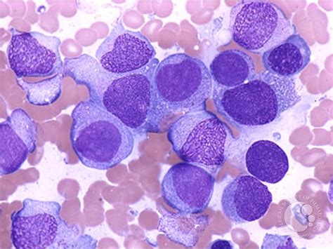 Acute Monocytic Leukemia - 1.