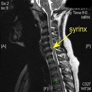 Pin by Elizabeth Rhoads on Syringomyelia | Radiology imaging, Mri ...