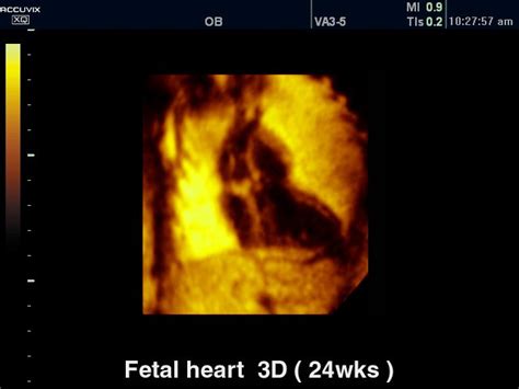 3d Ultrasound Of The Heart