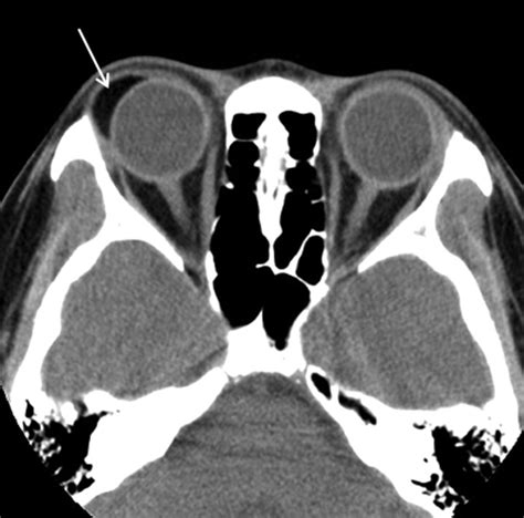 Subconjunctival Fat Prolapse And Dermolipoma Of The Orbit