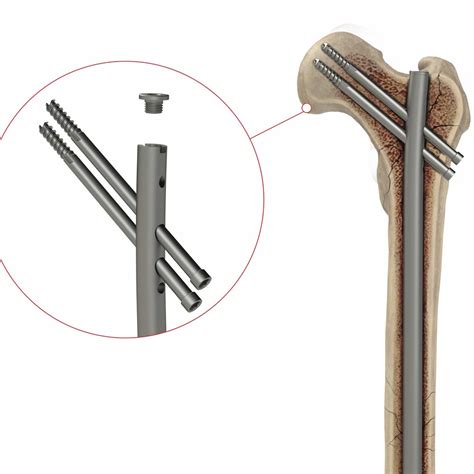 Clavo intramedular para fémur - 4T1-4001050 - Ases Orthopedics