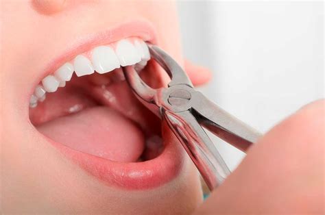 Extracciones Dentales En Gijón Dental Dindurra