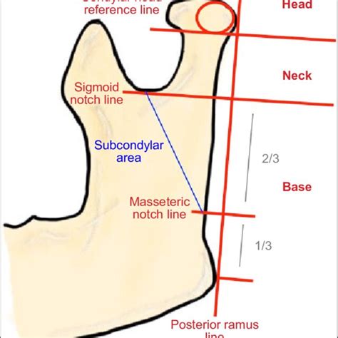 Diagram Of Classification Of Mandibular Condyle Download Scientific Diagram