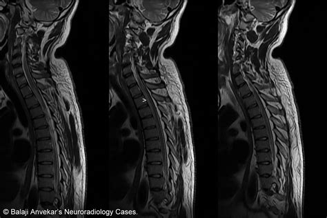 The Spinal Cord: Mri Of The Spinal Cord