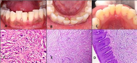 A Postoperative Labial View Showing Complete Healing After 2 Weeks