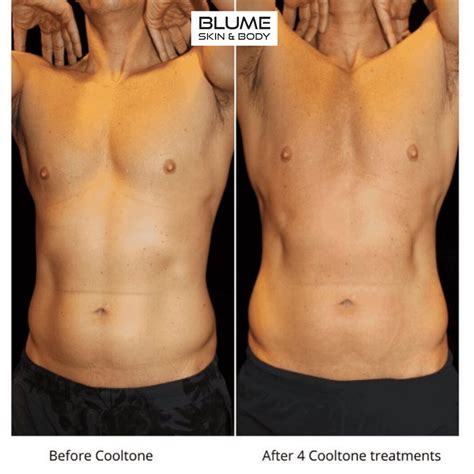 Body Sculpting Before After Photos Scottsdale Arizona