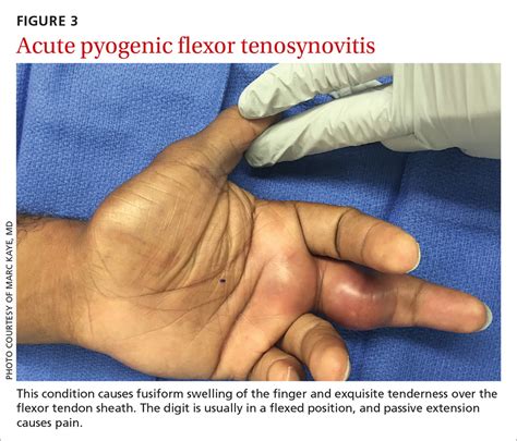 Infectious Flexor Tenosynovitis