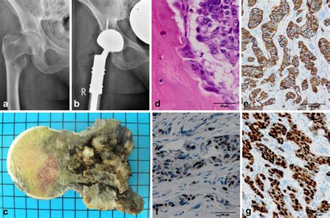 Clinical Case Of A 49 Year Old Female Patient With Breast Cancer